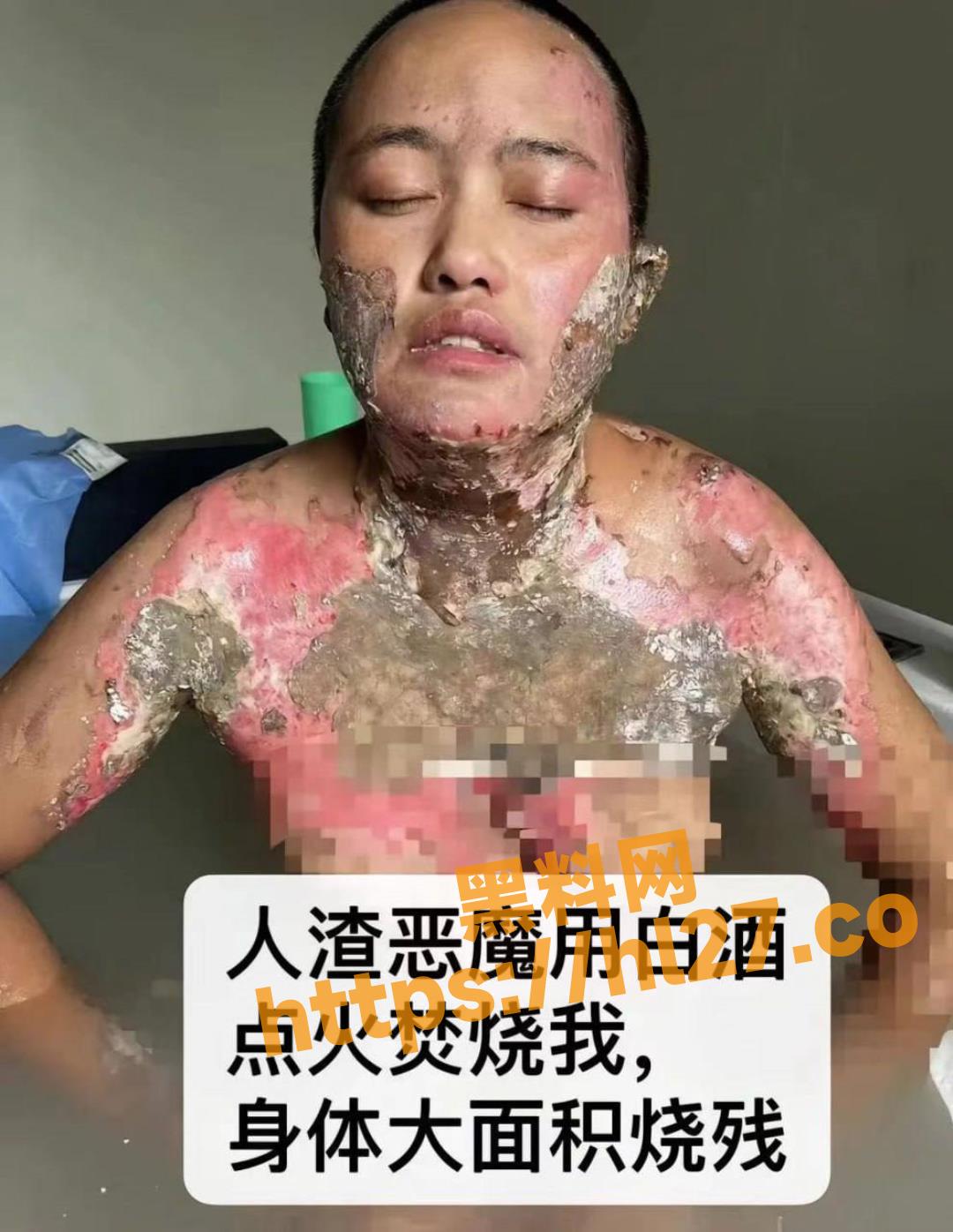 四川凉山女子称被丈夫家暴后被泼酒点火导致自己大面积烧伤，画面可能引起不适，慎入