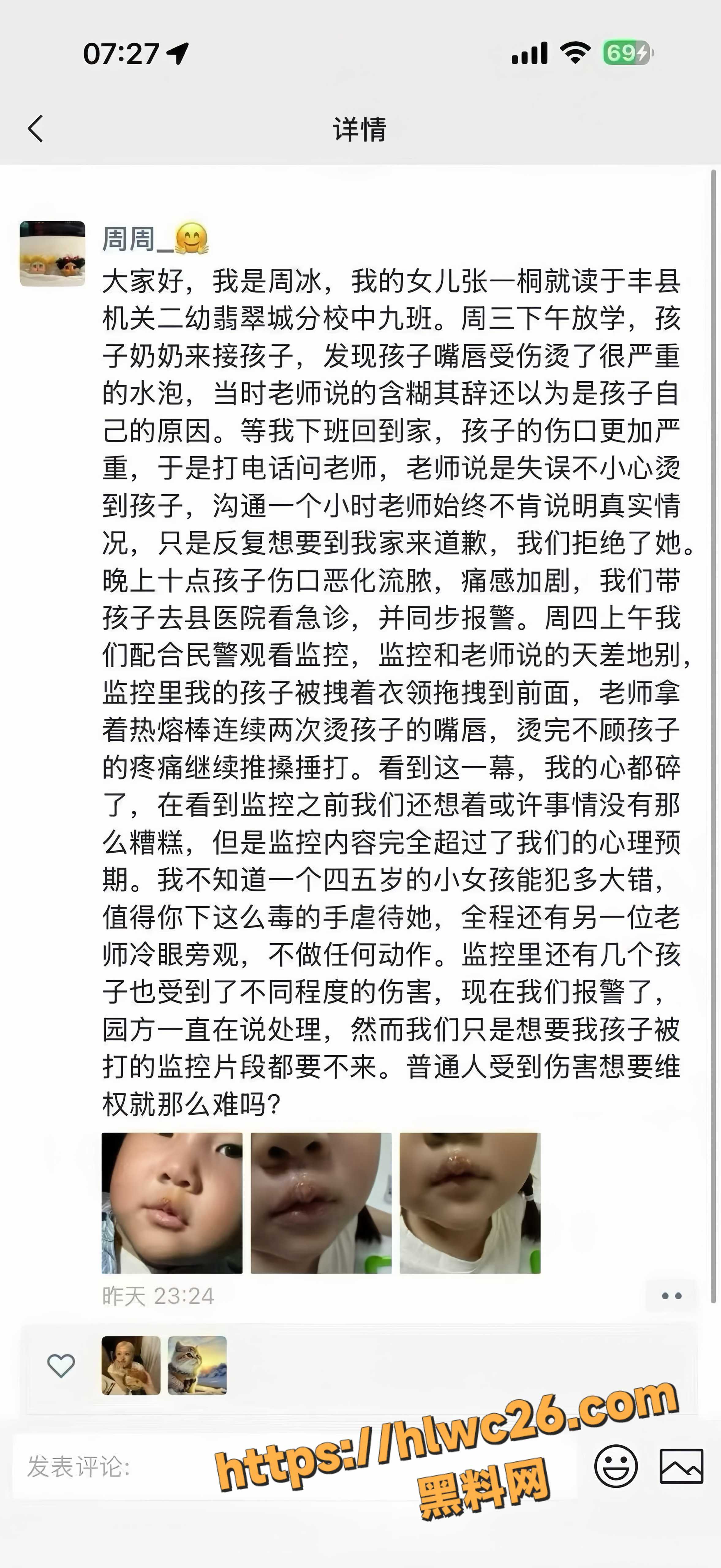 江苏徐州丰县一幼儿园老师 用热熔胶枪烫伤女孩嘴唇 手段残忍引发全网热议