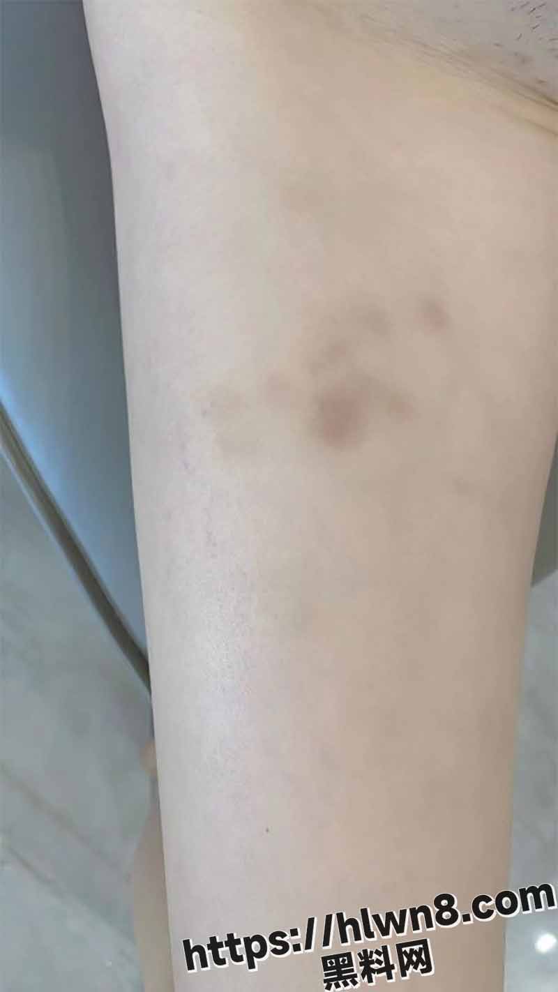 最爱极品骚嫂子 我和大嫂两败俱伤 身上多处淤青 给我心疼坏了 全力猛插蜜穴 我要好好爱抚她