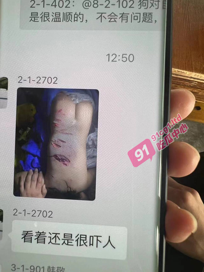 10月16日成都崇州 恒大西辰绿洲小区内狗咬小孩事件 右边肾脏被咬掉一半