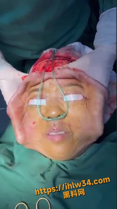 这是你们了解的拉皮手术嘛？小仙女们快来看看，一张脸都快被剐下来了!重口慎入