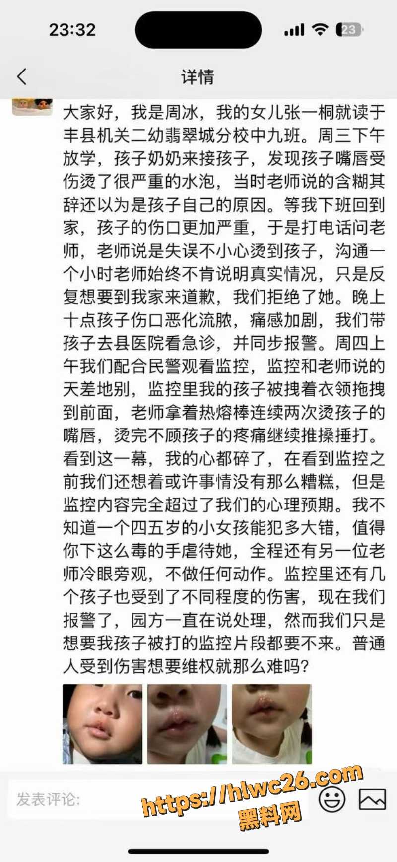 独家爆料 江苏徐州丰县机关二幼老师 陈玉 用热熔胶烫伤子孩 虐待事件曝光